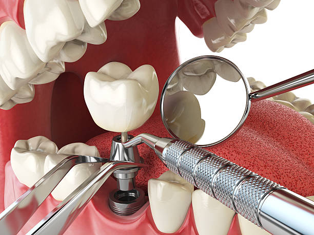 Best Emergency Treatment for Dental Infections or Abscesses in Cleveland, GA