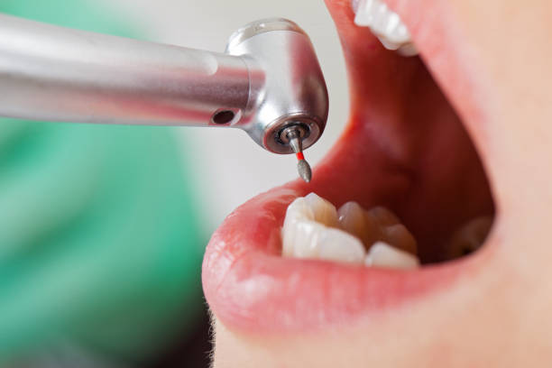 Best Emergency Dental Care for Broken or Chipped Teeth in Cleveland, GA